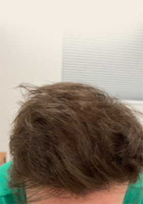 hair transplant photos