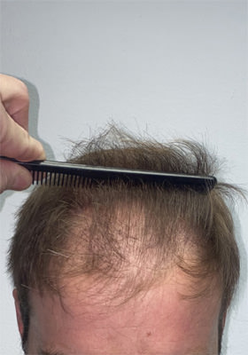 hair transplant photos