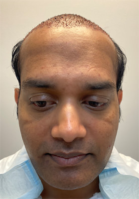 hair transplant photos