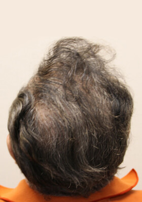 hair transplant photos