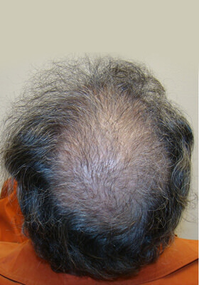 hair transplant photos