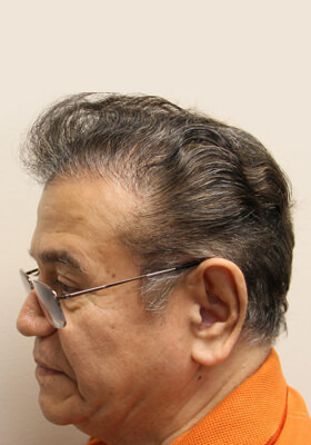 hair transplant photos