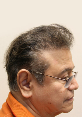 hair transplant before after Photos