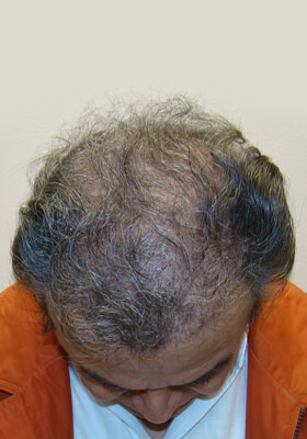 hair transplant photos