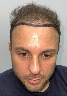 hair transplant photos