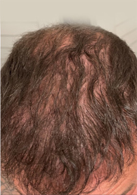 hair transplant before after Photos