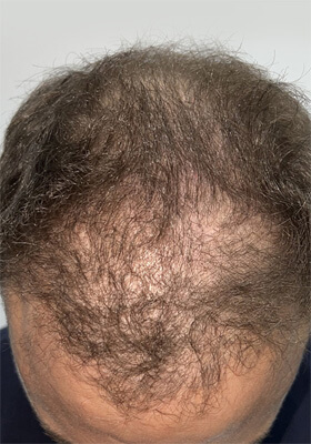 hair transplant before after Photos