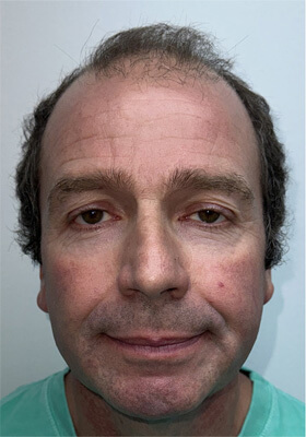 hair transplant photos