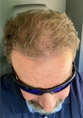 hair transplant photos