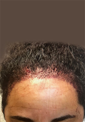 hair transplant before after Photos