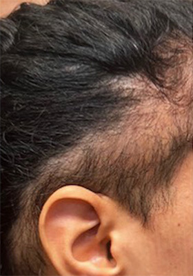 hair transplant photos