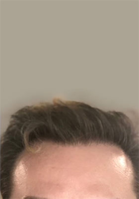 hair transplant before after Photos