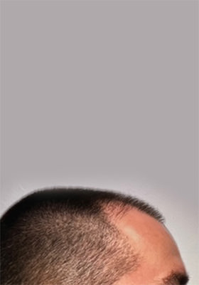 hair transplant photos