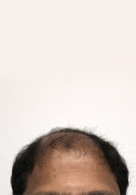 hair transplant before after Photos