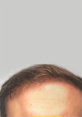 hair transplant photos