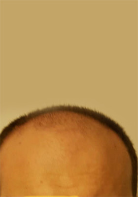 hair transplant before after Photos