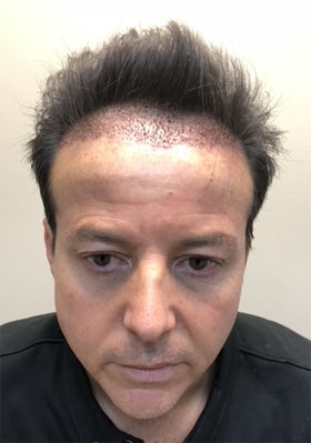 hair transplant photos