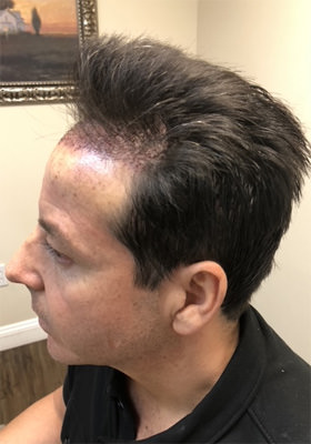 hair transplant photos