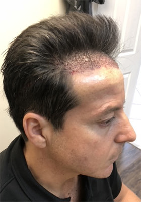 hair transplant photos