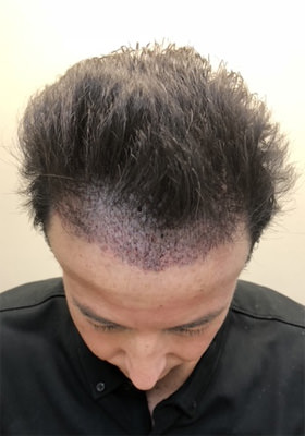 hair transplant photos