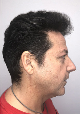 hair transplant photos