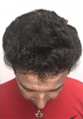 hair transplant before after Photos