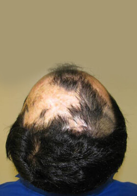 hair transplant photos