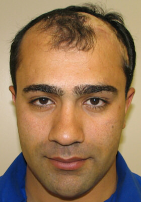 hair transplant photos