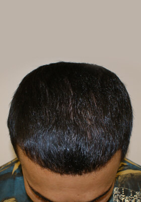 Patients Before After Photos - Rahim - Hair Transplant Updates