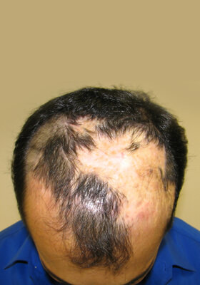 Dr Brett Bolton Patient Testimonial Photos - Rahim - Hair Transplant Updates