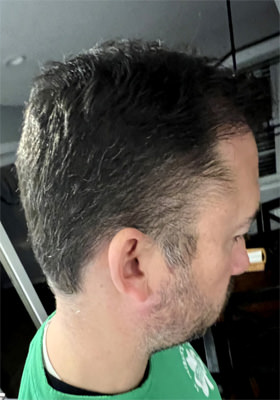 hair transplant photos