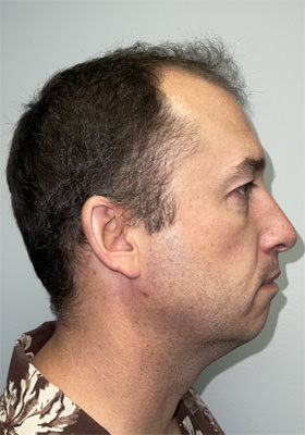 hair transplant photos