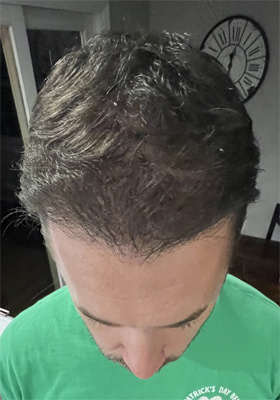 hair transplant photos