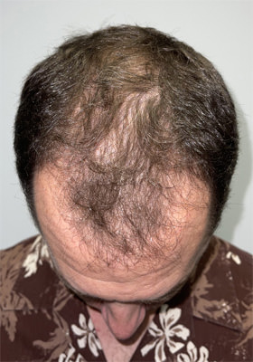 hair transplant photos