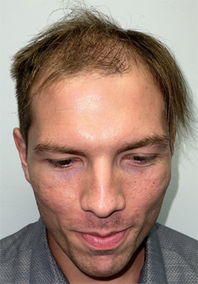 hair transplant before after Photos