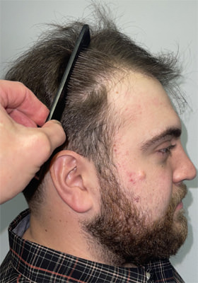 hair transplant before after Photos