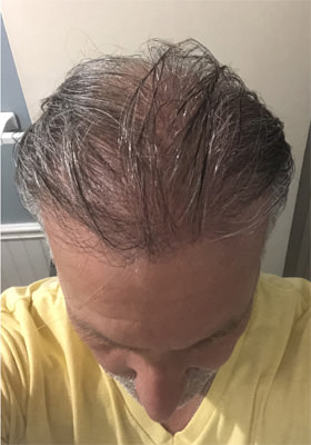 hair transplant photos