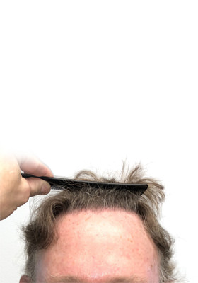 hair transplant before after Photos