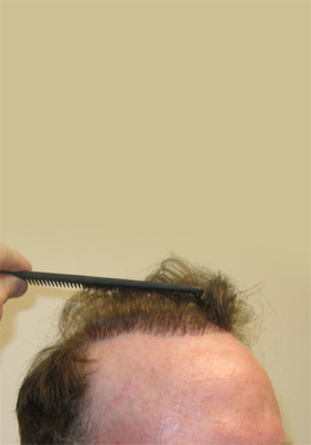 hair transplant photos