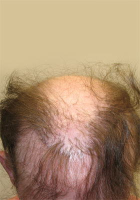 hair transplant photos