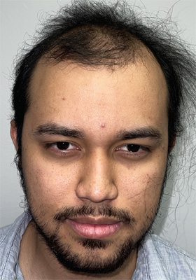 hair transplant photos