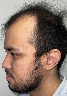 hair transplant photos