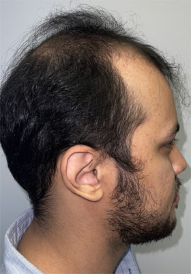 hair transplant before after Photos