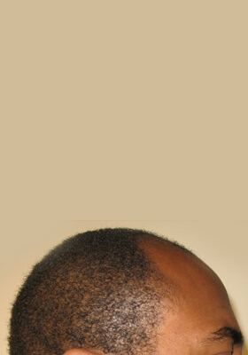 hair transplant photos