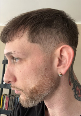 hair transplant photos