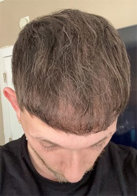 hair transplant photos