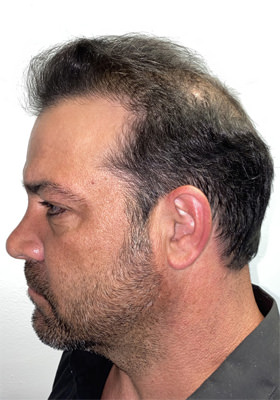 hair transplant photos