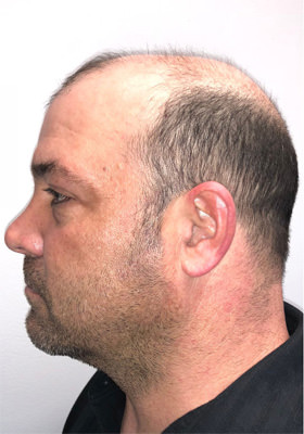 hair transplant before after Photos