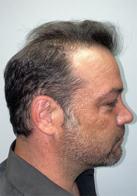 hair transplant photos