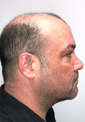 hair transplant photos